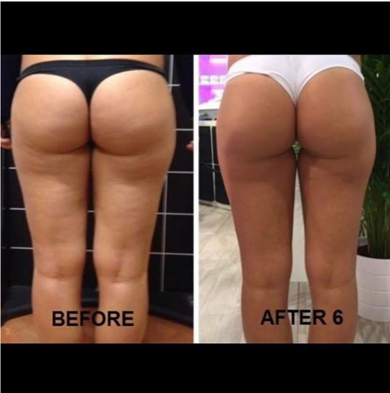 Body Sculpt GC Beauty Salon Before and After
